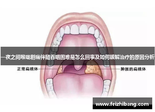 一夜之间喉咙剧痛伴随吞咽困难是怎么回事及如何缓解治疗的原因分析